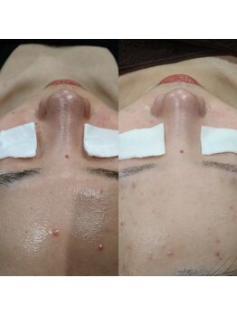 ボーソリューション(Beau-Solution)/【10代　毛穴ニキビケア】