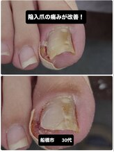 巻き爪じゅん 船橋店/巻き爪・陥入爪の痛み改善