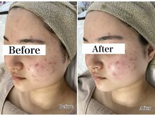 ホリシア 博多(HORISHIA)/ハーブピーリング/ニキビケア