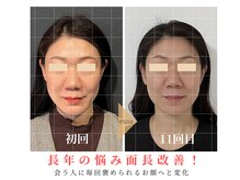 エソア(esoa)/40代　小顔矯正