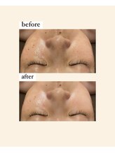 ディサイドロー(DECIDE L.A.W)/毛穴改善