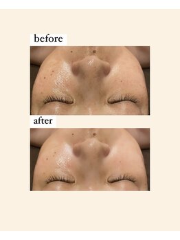 ディサイドロー(DECIDE L.A.W)/毛穴改善