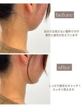 サロンドベルム(Salon de BELME)/シュガーリング：before/after