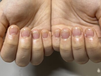 爪悩み専門店/ネイルNGの方も深爪矯正