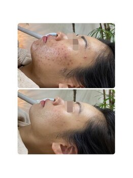 ニキビケア研究所 吉祥寺店/全体のニキビ、茶色い跡