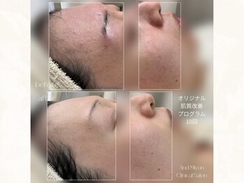 アンド ミヨン(And Miyon)/オリジナルケア10回