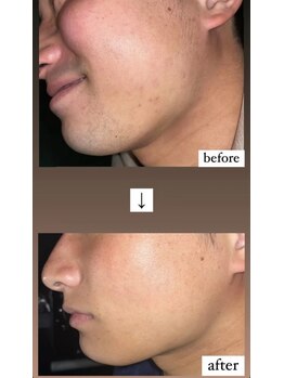 オーシャンズ 谷町四丁目店(OCEANS)/鬚脱毛施術症例