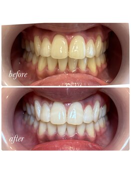 ティースホワイトニング 沖縄うるま市(Teeth Whitning)/ビフォーアフター 20代 女性