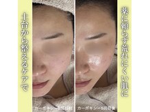 ハニエル(Haniel)/カーボキシー症例