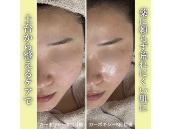 ハニエル(Haniel)/カーボキシー症例