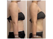 デトックスシェイプラボ 錦糸町(D:S Lab)の雰囲気(薄着の季節になってきました!二の腕もすっきり!)