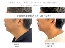 サボラミ(sabor A Mi)/顎下と首の間のお肉も落とせます