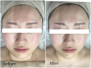 ルピア(L'pur)/むくみ、小顔ケア！