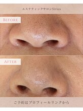 シリウス 辻堂店(Sirius)/毛穴悩みの方にもSiriusで！