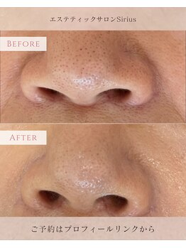 シリウス 辻堂店(Sirius)/毛穴悩みの方にもSiriusで!