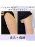 【ご新規様】41,000円→36,000円【赤み・傷跡】ボディトリートメント