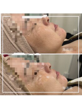 リリーガーデン 手稲店(Lily Garden)/ビフォーアフター【毛穴/シワ】