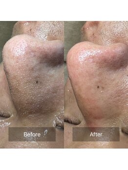 アネラ 難波(ANERA)/ハイドロスプラッシュ毛穴洗浄☆