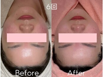 カレンジェビューティー(CarengeBeauty)/小顔矯正コルギ