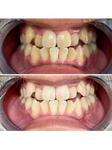 コガオファクトリー 北24条店(KOGAO FACTORY)/セルフホワイトニング