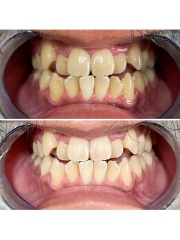 コガオファクトリー 北24条店(KOGAO FACTORY)/セルフホワイトニング