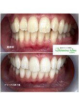 ホワイトニングサロン 名古屋駅店/【ホワイトニング施術例】