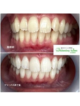 ホワイトニングサロン 名古屋駅店/【ホワイトニング施術例】