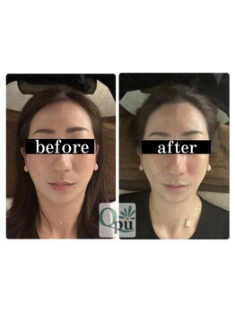 キュープ 福岡天神店(Qpu)/美顔器コース4回での変化