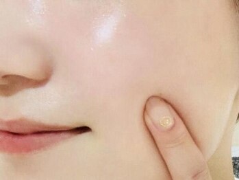 マル ン(Malu'n)の写真/ツルスベ肌が続く♪【《艶肌Wax》＋《光》の美肌顔脱毛¥11000→¥6500】で至近距離でも怖くない★