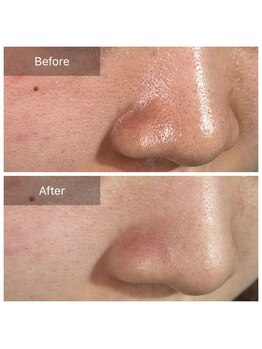 ピネ(pine)/Before After