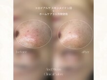 アンド ミヨン(And Miyon)/サロンケア＋ホームケア3ヶ月