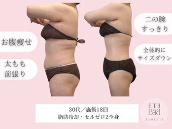 ベベティー(BEBETIE)/上半身痩せ☆期間10ヶ月