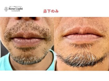 ヘルディン(heldin +555)/メンズ脱毛