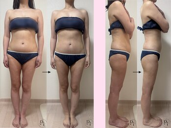 プラスワンビューティテン 新大阪店(Plus One Beauty)/ボディ/ハイパーナイフ/痩身