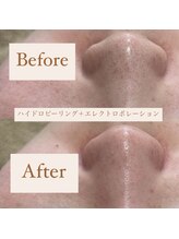 クリニカルホワイトケア 和泉府中店(クリニカルWHITEケア)/ハイドロ＋美容液導入