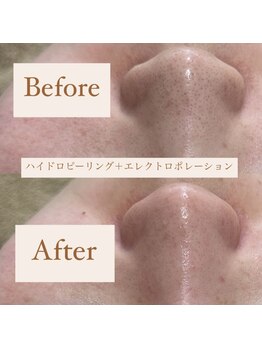 クリニカルホワイトケア 和泉府中店(クリニカルWHITEケア)/ハイドロ＋美容液導入