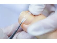 巻き爪ケアもお任せください。