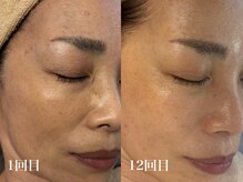 ホワイトアクア 北千住店(WHITE AQUA)/ララピール12回/しわしみ改善