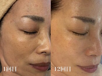 ホワイトアクア 北千住店(WHITE AQUA)/ララピール12回/しわしみ改善