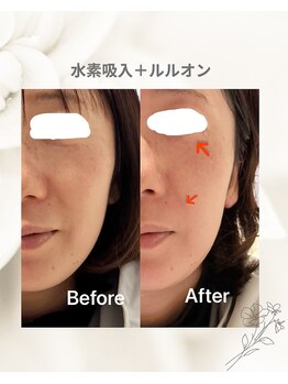 ヨサパーク そら(YOSA PARK)/ルルオン+水素酸素吸入の変化