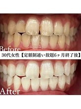 ホワイト 福岡天神店(WHITE)/ホワイトニングビフォーアフター