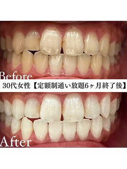 ホワイト 福岡天神店(WHITE)/ホワイトニングビフォーアフター