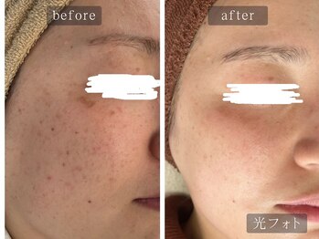 アムールサロン(Amour salon)/光フェイシャルでシミケア/新宿