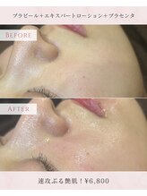 ユニ(uni.)/プラピール症例