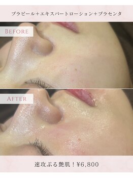 ユニ(uni.)/プラピール症例