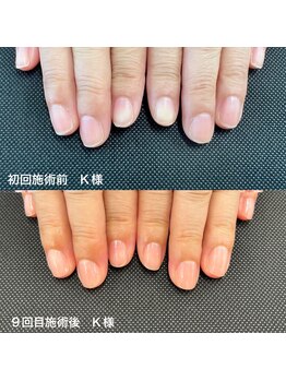 クレール(Clair)の写真/地爪育成でジェルなしで地爪をきれいにできる最強のネイルケアが登場！