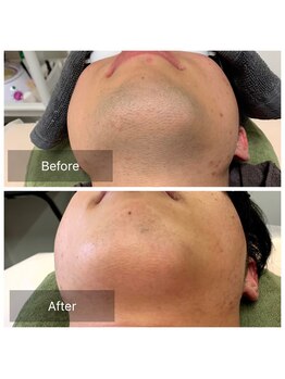 脱毛サロン メンズ 堂々/脱毛ビフォーアフター