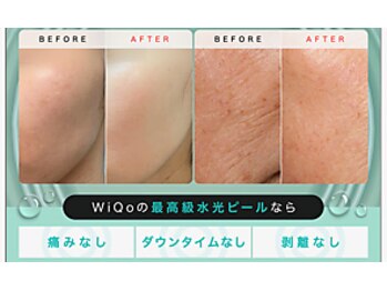 レミューズ(LES MUSES)/WIQo水光ピールアジア人向けに