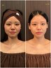 【驚愕ハリ艶・しわたるみケア】エイジングケア鍼×超高濃度幹細胞導入ダーマ