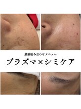 キビック(KIBIK)/【プラズマ×シミケア】